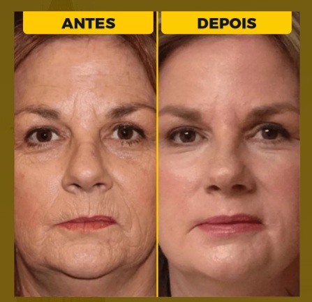 Skin Vid Ultra antes e depois