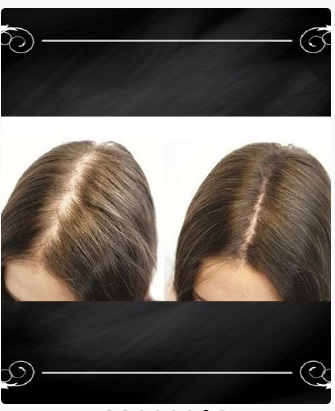 Manxidil Turbinado resultados em mulheres - imagens de antes e depois do tratamento