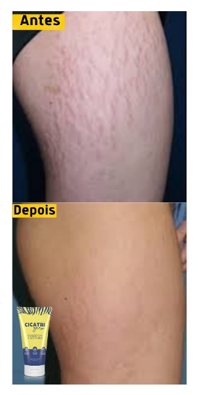 Cicatrizero antes e depois do tratamento