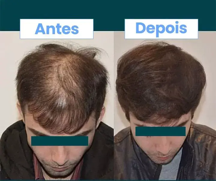 Fio Plus funciona? Imagens de antes e depois do tratamento.