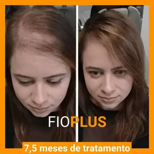 Fio Plus funciona? Imagens de antes e depois do tratamento.